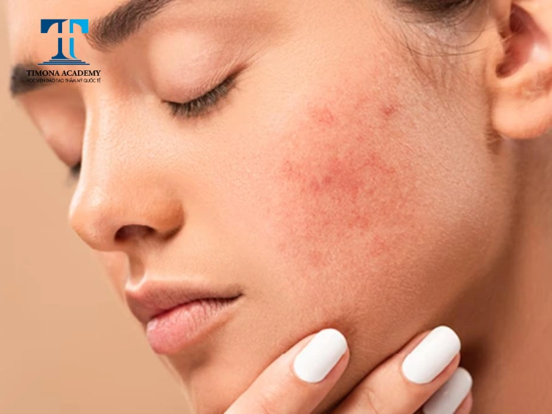 Da nổi mụn dị ứng do bị nhiễm độc corticoid