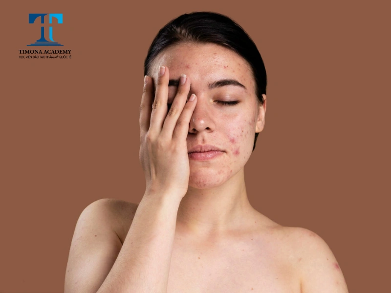 Ngưng dùng các sản phẩm gây kích ứng cho da