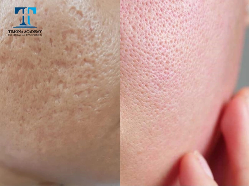 Phân biệt sẹo đáy nhọn và lỗ chân lông to