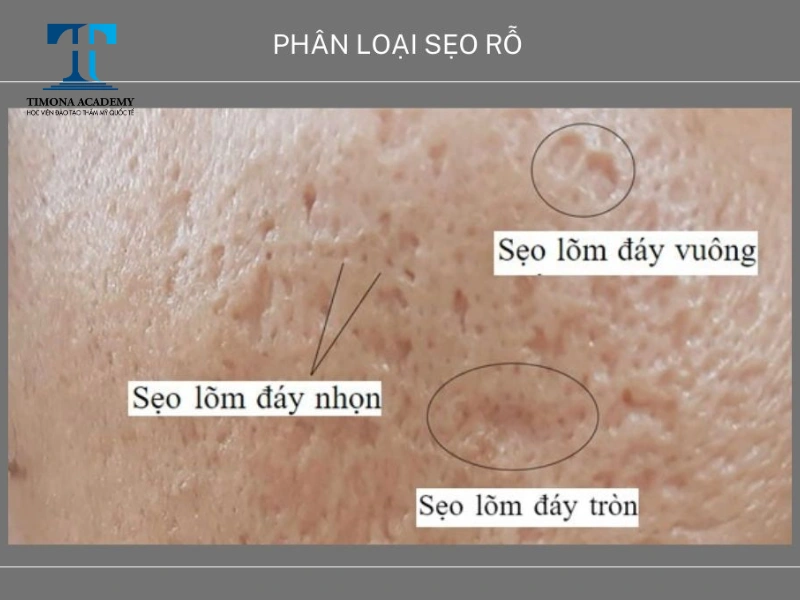 Sẹo lõm đáy tròn thường có kích thước khá lớn