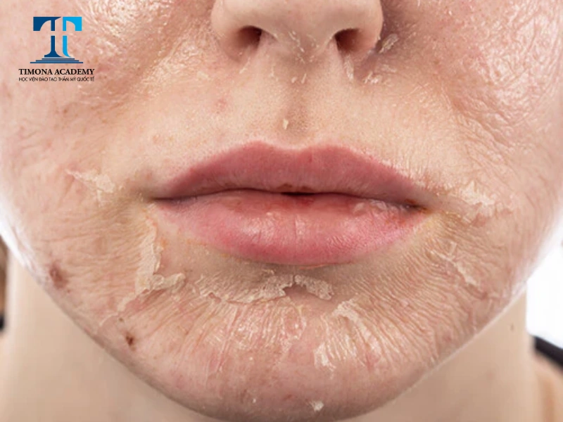 Chemical Peel - Phương pháp điều trị sẹo đáy tròn hiệu quả