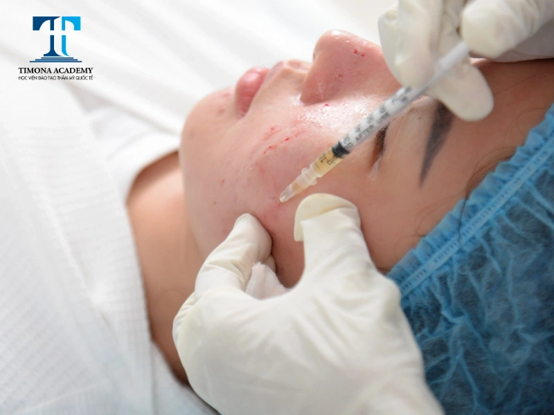 Công nghệ PRP là phương pháp điều trị sẹo đáy tròn hiệu quả hiện nay