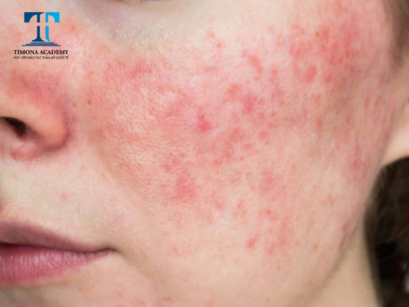Skincare cho da nhạy cảm đúng cách giúp hạn chế tình trạng kích ứng, nổi mẩn đỏ và bong tróc da