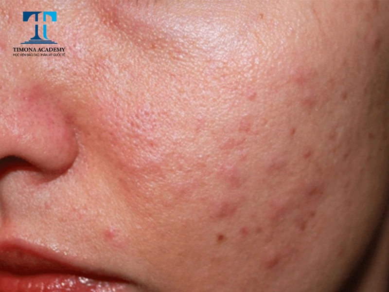 Skincare da dầu mụn đúng cách giúp giảm mụn hiệu quả