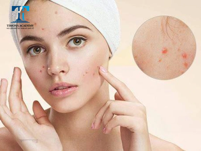 Bôi kem chống nắng là bước không thể thiếu trong quy trình skincare da dầu mụn buổi sáng